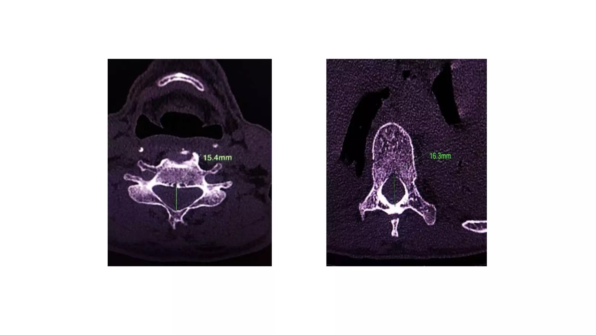 Normal Spinal canal diameters
THORACIC SPINE
CERVICAL SPINE
 