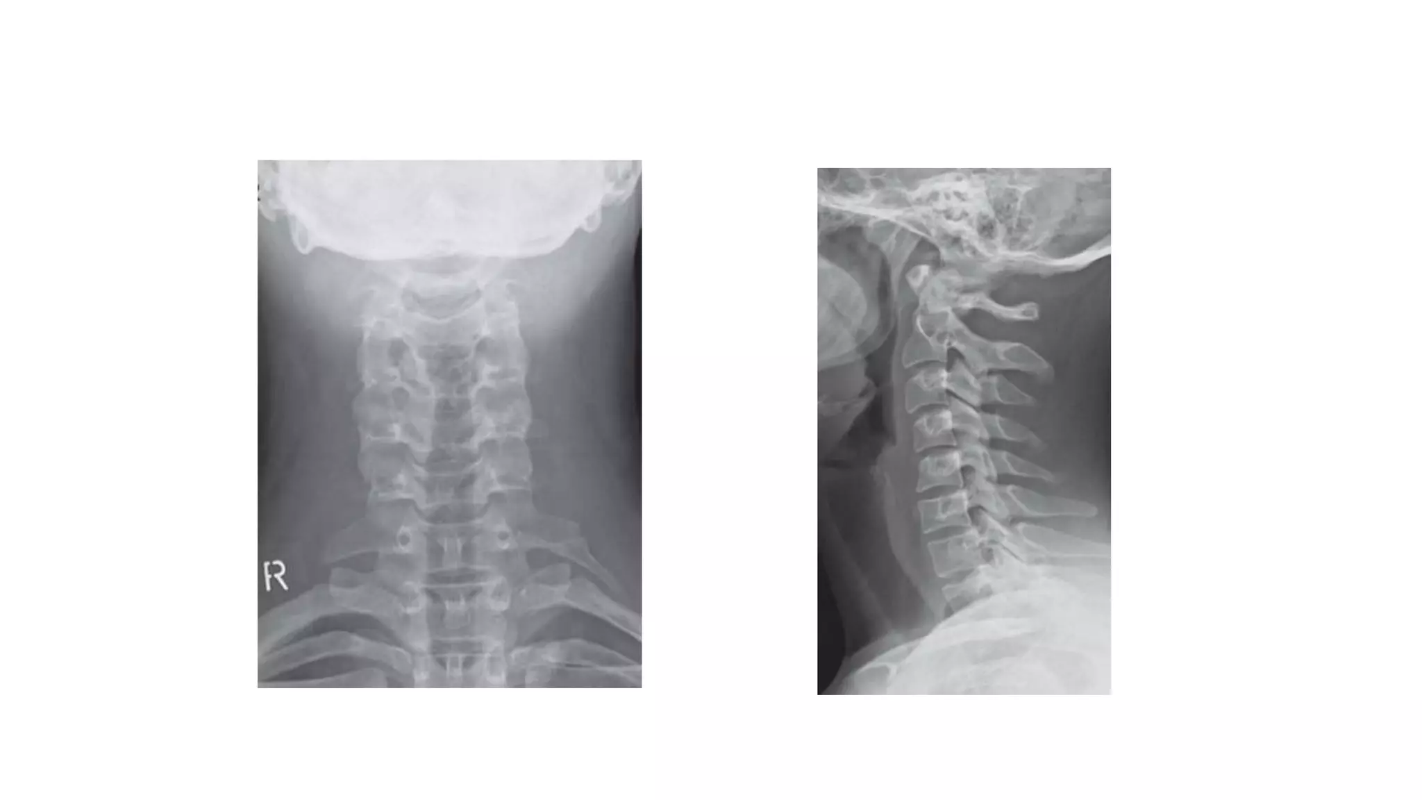Normal plain radiography of the cervical spine
ANTERIOR POSTERIOR
VIEW
LATERAL VIEW
 