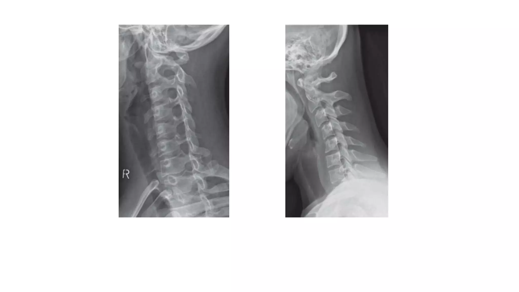 Right oblique view Dynamic flexion view
 