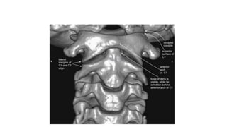 This three-dimensional reconstruction from computed tomography (CT) axial images focuses on the occipital–
cervical junction and the C1-2 (atlantoaxial) junction
 