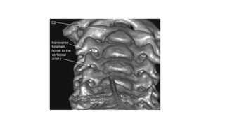 This three-dimensional CT model is oriented with the observer looking cephalad along the anterior
surface of the cervical spine. A series of holes perforating the transverse processes of each vertebra
can be seen—the transverse foramen.
 
