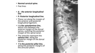 • Normal cervical spine.
• Five lines
• A : the anterior longitudinal
line
• P: Posterior longitudinal line.
• These run along the margin of
the anterior and posterior
longitudinal ligament.
• L is the spinolaminar line,
which runs between the
anterior margin of the dorsal
spines, outlining the posterior
margin of the spinal canal.
• The asterisks represent the
spinous line, along the
posterior margin of the dorsal
spines.
• F is the posterior pillar line,
along the posterior margins of
the articular pillars
 