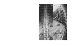 Thoracic spine
X-ray in AP and Lateral
projections.
Vertebral body (star ) of
T12 with rib hypoplasia;
T10–T11 intervertebral
foramina (circle ); T11
right pedicle(arrowhead )
 