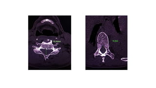 Normal Spinal canal diameters
THORACIC SPINE
CERVICAL SPINE
 