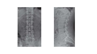 Normal plain radiography of the lumbar spine
POSTERIOR ANTERIOR VIEW LATERAL VIEW
 