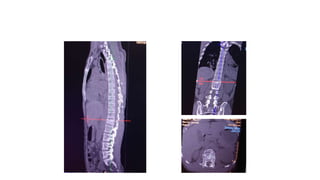 Burst fracture of L1 vertebrae
Saggital, Coronal and Axial
 