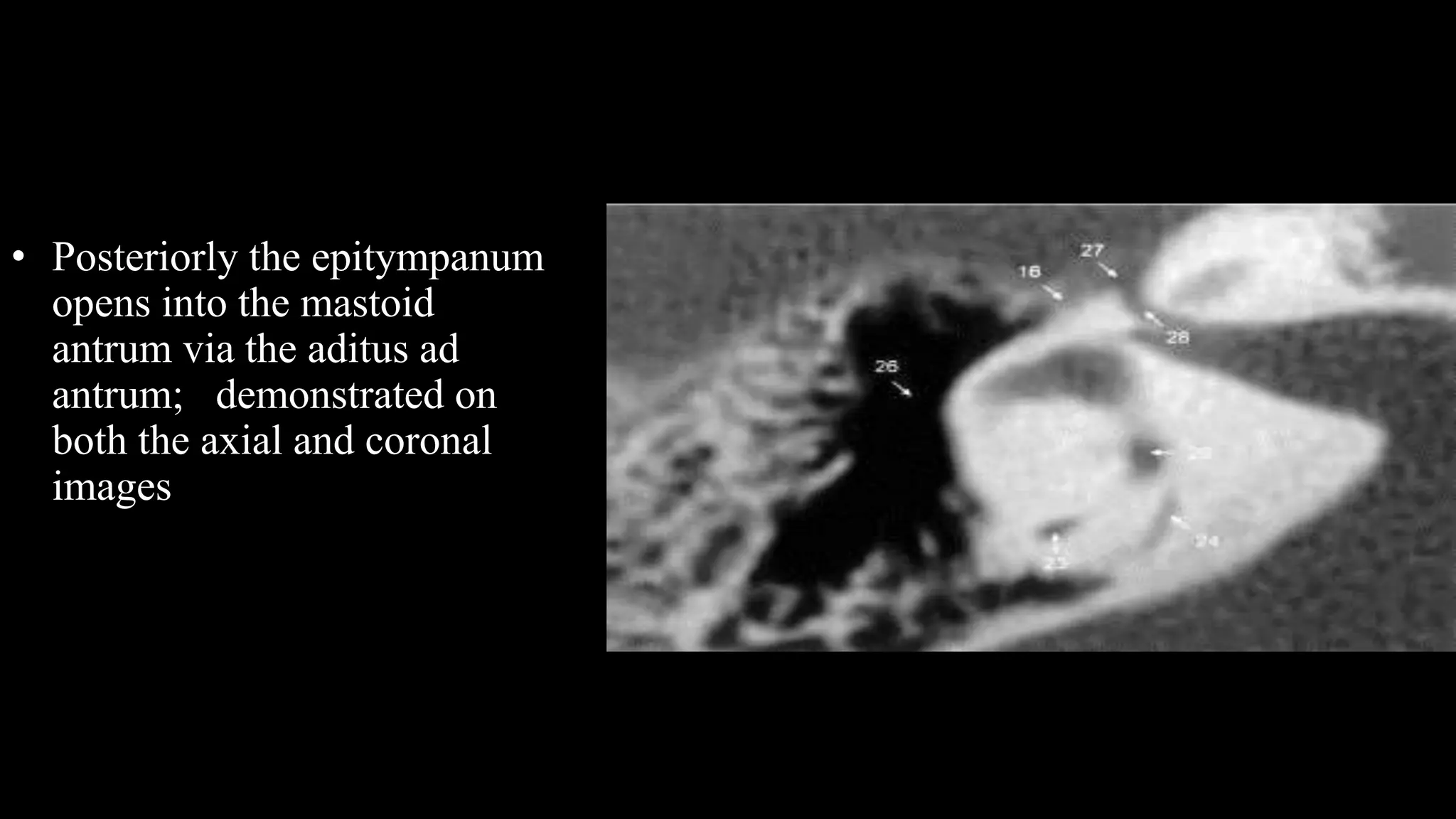 • Posteriorly the epitympanum
opens into the mastoid
antrum via the aditus ad
antrum; demonstrated on
both the axial and coronal
images
 