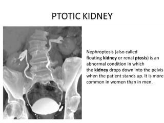 CT Urography | PPTX