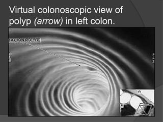 Virtual colonoscopic view of
polyp (arrow) in left colon.
 