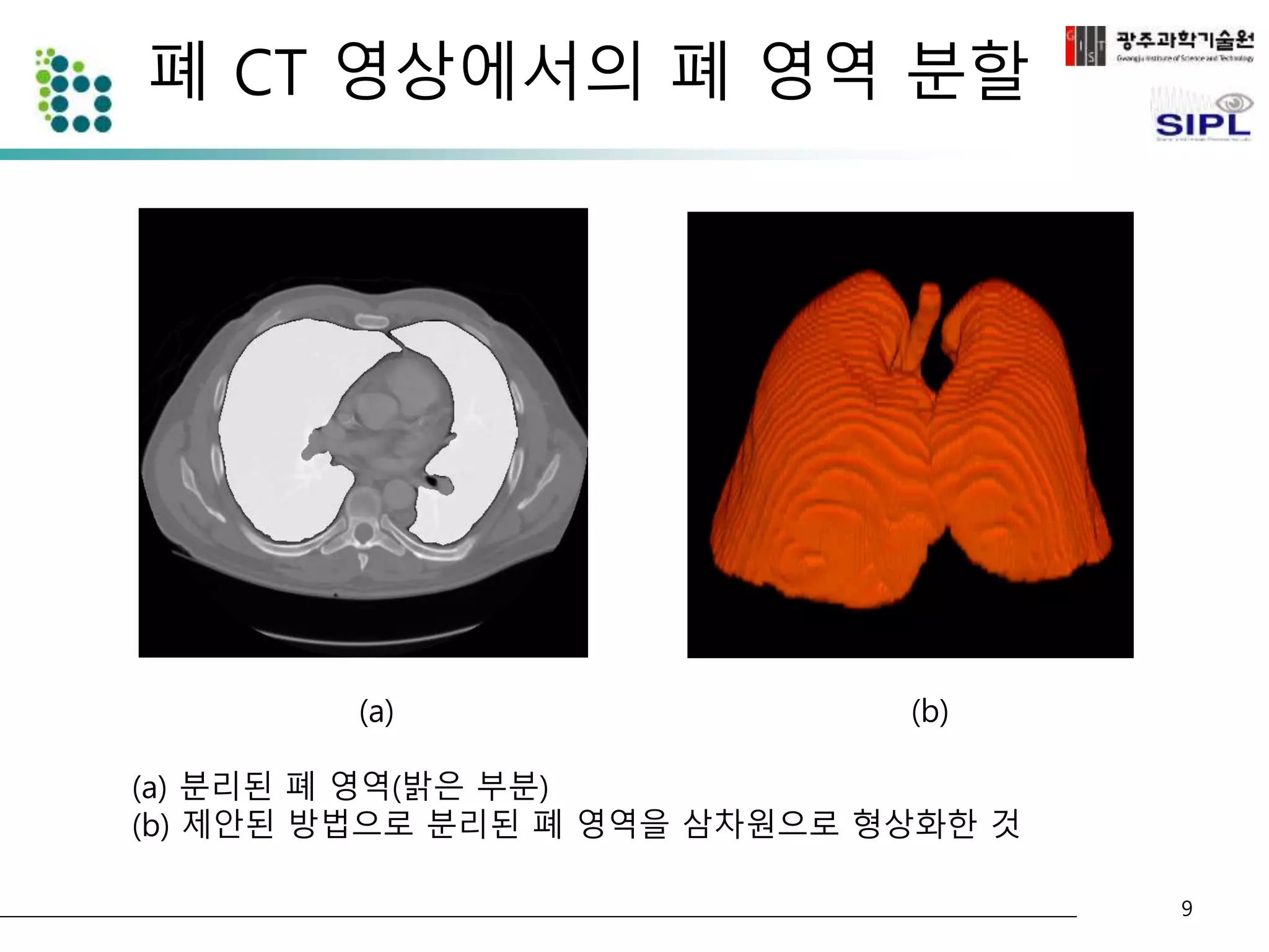 폐 CT 영상에서의 폐 영역 분할 
(a) (b) 
(a) 분리된 폐 영역(밝은 부분) 
(b) 제안된 방법으로 분리된 폐 영역을 삼차원으로 형상화한 것 
9 
 