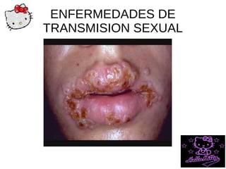 ENFERMEDADES DE
TRANSMISION SEXUAL
 