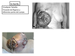 Cx: Fase IIIa.
•Cualquier Tamaño.
•Invasión de Órganos y
diferentes partes del cuerpo.
 