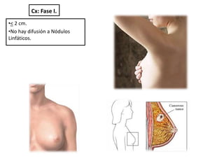 Cx: Fase I.
•< 2 cm.
•No hay difusión a Nódulos
Linfáticos.
 
