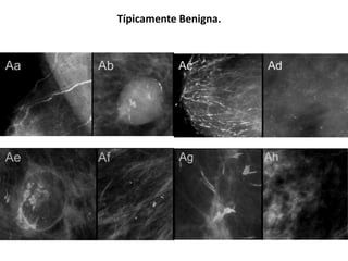 Típicamente Benigna.
 