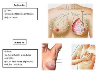 Cx: Fase IIa.
•< 2 cm.
•Difusión a Nódulos Linfáticos.
•Bajo el brazo.
Cx: Fase IIb.
•2-5 cm.
•No hay difusión a Nódulos
Linfáticos.
•> 5cm. Pero no se expande a
Nódulos Linfáticos.
 