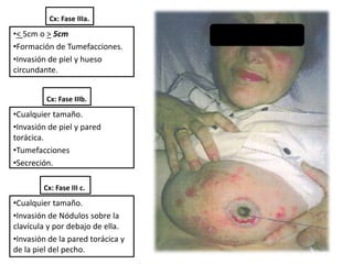 Cx: Fase IIIa.
•< 5cm o > 5cm
•Formación de Tumefacciones.
•Invasión de piel y hueso
circundante.
Cx: Fase IIIb.
•Cualquier tamaño.
•Invasión de piel y pared
torácica.
•Tumefacciones
•Secreción.
Cx: Fase III c.
•Cualquier tamaño.
•Invasión de Nódulos sobre la
clavícula y por debajo de ella.
•Invasión de la pared torácica y
de la piel del pecho.
 