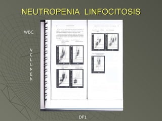 NEUTROPENIA  LINFOCITOSIS VOLUMEN WBC DF1 
