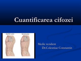 Cuantificarea cifozeiCuantificarea cifozei
Medic rezidentMedic rezident
Dr.Colesniuc ConstantinDr.Colesniuc Constantin
 