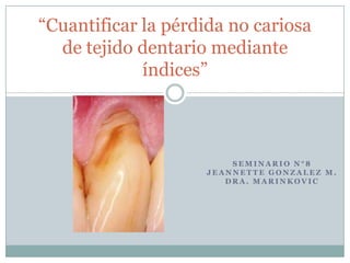 “Cuantificar la pérdida no cariosa
  de tejido dentario mediante
             índices”



                        SEMINARIO N°8
                    JEANNETTE GONZALEZ M.
                       DRA. MARINKOVIC
 