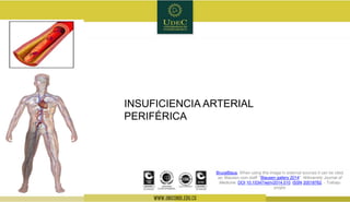 INSUFICIENCIA ARTERIAL
PERIFÉRICA
BruceBlaus. When using this image in external sources it can be cited
as: Blausen.com staff. "Blausen gallery 2014". Wikiversity Journal of
Medicine. DOI:10.15347/wjm/2014.010. ISSN 20018762. - Trabajo
propio
 
