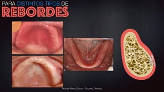 Nicolás Pérez Quiroz - Cirujano Dentista
HUESOMUCOSA
PARA DISTINTOS TIPOS DE
REBORDES
 