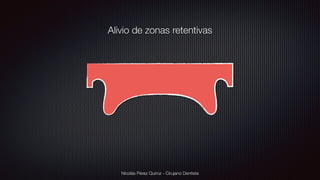 Nicolás Pérez Quiroz - Cirujano Dentista
Alivio de zonas retentivas
 