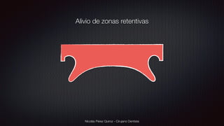 Nicolás Pérez Quiroz - Cirujano Dentista
Alivio de zonas retentivas
 