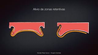 Nicolás Pérez Quiroz - Cirujano Dentista
Alivio de zonas retentivas
 