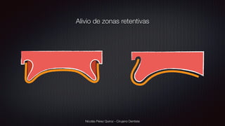 Nicolás Pérez Quiroz - Cirujano Dentista
Alivio de zonas retentivas
 