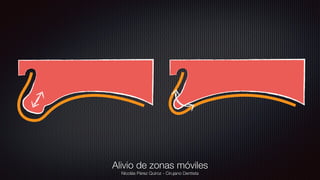 Nicolás Pérez Quiroz - Cirujano Dentista
Alivio de zonas móviles
 