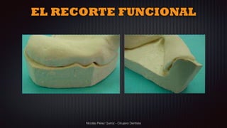 Nicolás Pérez Quiroz - Cirujano Dentista
EL RECORTE FUNCIONAL
 