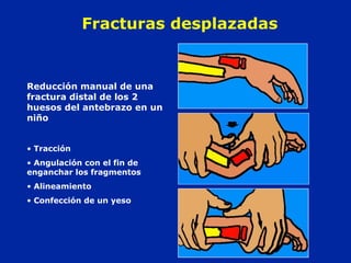 Fracturas desplazadas 
Reducción manual de una 
fractura distal de los 2 
huesos del antebrazo en un 
niño 
• Tracción 
• Angulación con el fin de 
enganchar los fragmentos 
• Alineamiento 
• Confección de un yeso 
 
