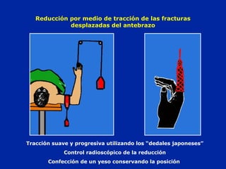 Reducción por medio de tracción de las fracturas 
desplazadas del antebrazo 
Tracción suave y progresiva utilizando los “dedales japoneses” 
Control radioscópico de la reducción 
Confección de un yeso conservando la posición 
 