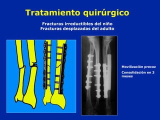 Tratamiento quirúrgico 
Fracturas irreductibles del niño 
Fracturas desplazadas del adulto 
Movilización precoz 
Consolidación en 3 
meses 
 