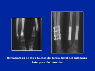 Osteosíntesis de los 2 huesos del tercio distal del antebrazo 
Interposición muscular 
 