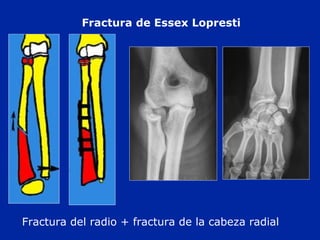Fractura de Essex Lopresti 
Fractura del radio + fractura de la cabeza radial 
 