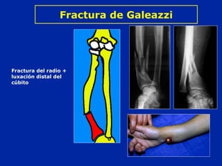 Fractura de Galeazzi 
Fractura del radio + 
luxación distal del 
cúbito 
 