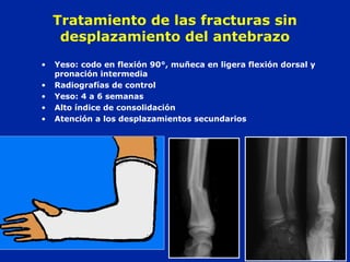 Tratamiento de las fracturas sin 
desplazamiento del antebrazo 
• Yeso: codo en flexión 90°, muñeca en ligera flexión dorsal y 
pronación intermedia 
• Radiografías de control 
• Yeso: 4 a 6 semanas 
• Alto índice de consolidación 
• Atención a los desplazamientos secundarios 
 