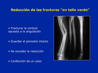 Reducción de las fracturas ““eenn ttaalllloo vveerrddee”” 
• Fracturar la cortical 
opuesta a la angulación 
• Guardar el periostio intacto 
• No exceder la reducción 
• Confección de un yeso 
 