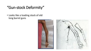 “Gun-stock Deformity”
• Looks like a loading stock of old
long barrel guns
 