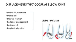DISPLACEMENTS THAT OCCUR AT ELBOW JOINT
• Medial displacement
• Medial tilt
• Internal rotation
• Posterior displacement
• Posterior tilt
• Proximal migration
DISTAL FRAGMENT
 