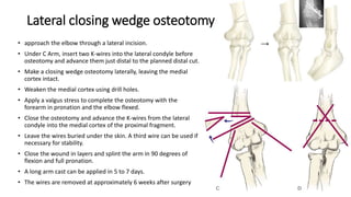 Lateral closing wedge osteotomy
• approach the elbow through a lateral incision.
• Under C Arm, insert two K-wires into the lateral condyle before
osteotomy and advance them just distal to the planned distal cut.
• Make a closing wedge osteotomy laterally, leaving the medial
cortex intact.
• Weaken the medial cortex using drill holes.
• Apply a valgus stress to complete the osteotomy with the
forearm in pronation and the elbow flexed.
• Close the osteotomy and advance the K-wires from the lateral
condyle into the medial cortex of the proximal fragment.
• Leave the wires buried under the skin. A third wire can be used if
necessary for stability.
• Close the wound in layers and splint the arm in 90 degrees of
flexion and full pronation.
• A long arm cast can be applied in 5 to 7 days.
• The wires are removed at approximately 6 weeks after surgery
 