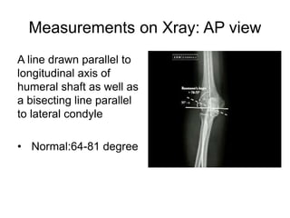 Measurements on Xray: AP view
A line drawn parallel to
longitudinal axis of
humeral shaft as well as
a bisecting line parallel
to lateral condyle
• Normal:64-81 degree
 