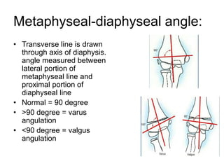 Metaphyseal-diaphyseal angle:
• Transverse line is drawn
through axis of diaphysis.
angle measured between
lateral portion of
metaphyseal line and
proximal portion of
diaphyseal line
• Normal = 90 degree
• >90 degree = varus
angulation
• <90 degree = valgus
angulation
 