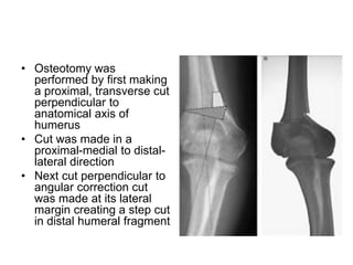• Osteotomy was
performed by first making
a proximal, transverse cut
perpendicular to
anatomical axis of
humerus
• Cut was made in a
proximal-medial to distal-
lateral direction
• Next cut perpendicular to
angular correction cut
was made at its lateral
margin creating a step cut
in distal humeral fragment
 