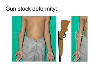 Gun stock deformity:
 