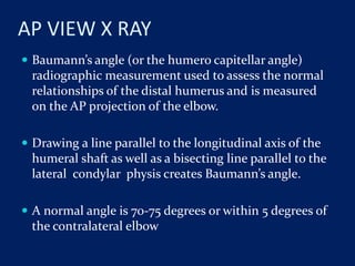 AP VIEW X RAY
 Baumann’s angle (or the humero capitellar angle)
radiographic measurement used to assess the normal
relationships of the distal humerus and is measured
on the AP projection of the elbow.
 Drawing a line parallel to the longitudinal axis of the
humeral shaft as well as a bisecting line parallel to the
lateral condylar physis creates Baumann’s angle.
 A normal angle is 70-75 degrees or within 5 degrees of
the contralateral elbow
 