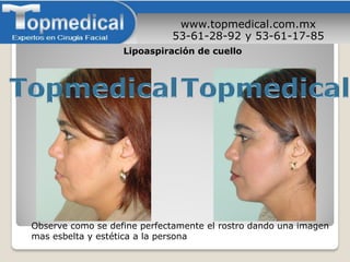 www.topmedical.com.mx
53-61-28-92 y 53-61-17-85
Observe como se define perfectamente el rostro dando una imagen
mas esbelta y estética a la persona
Lipoaspiración de cuello
 