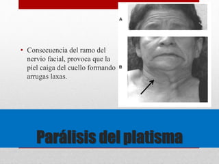 • Consecuencia del ramo del 
nervio facial, provoca que la 
piel caiga del cuello formando 
arrugas laxas. 
Parálisis del platisma 
 