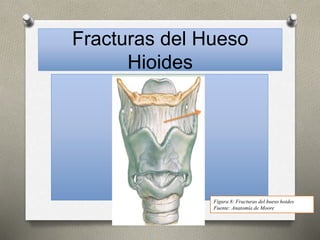 Fracturas del Hueso
Hioides
Figura 8: Fracturas del hueso hoides
Fuente: Anatomía de Moore